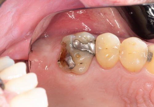 Broken amalgam filling
