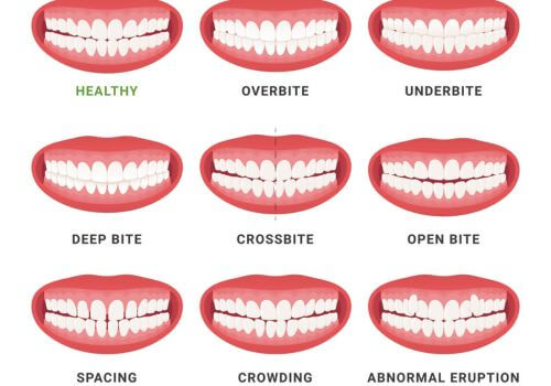 Different types of orthodontic issues.