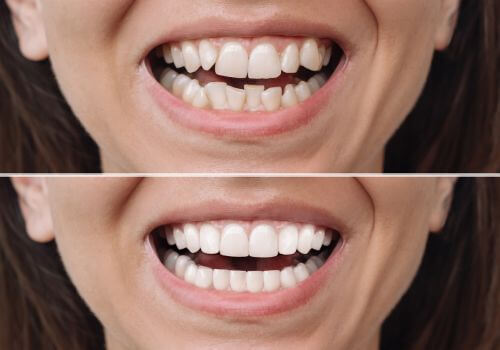 Different types of orthodontic issues. Before and After braces.