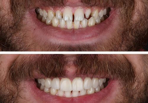 Cosmetic dentistry options before and after.