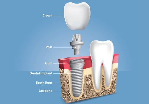 Diagram of how dental implant works in the mouth.