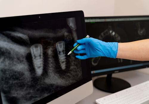 X-Rays of dental implants.