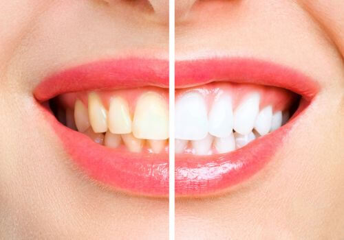 Comparison of a woman's smile before and after professional teeth whitening