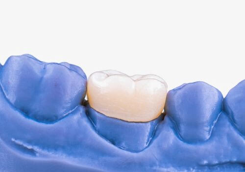 Cerec Same Day Crown illustration.
