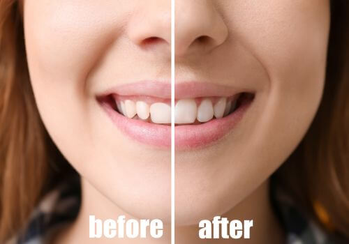 Gummy smile treatment before and after image.