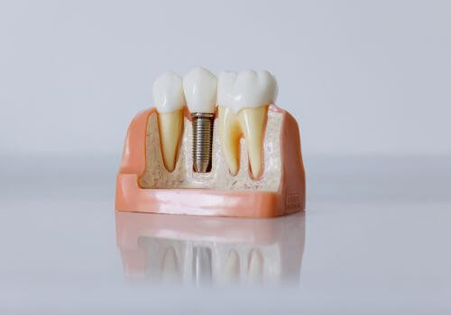 Dental model showing dental implant