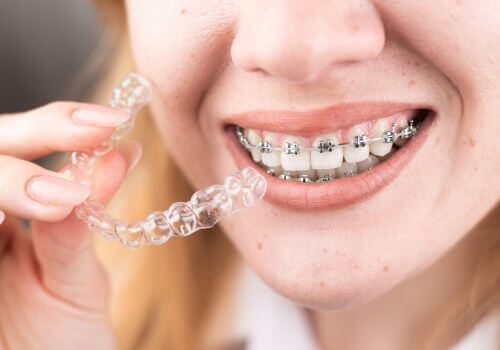 Teen girl with braces showing Invisalign.