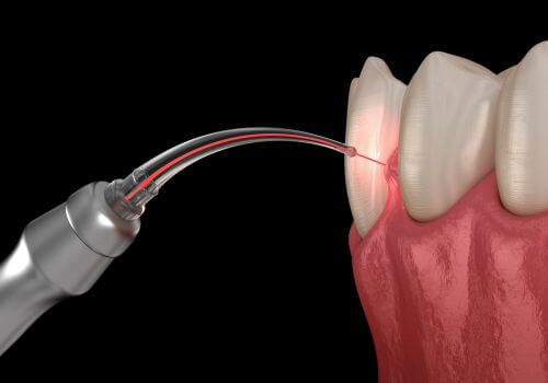 Dental laser virtual gum recession for LANAP procedure..
