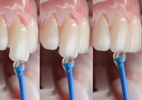 Veneers being placed on teeth
