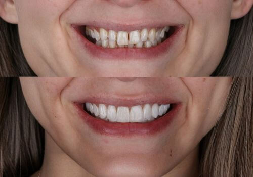 Woman veneers. Smile makeover after picture.