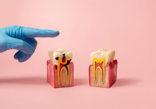 A model showing dental cavity. Cavities are one of the most common dental problems.