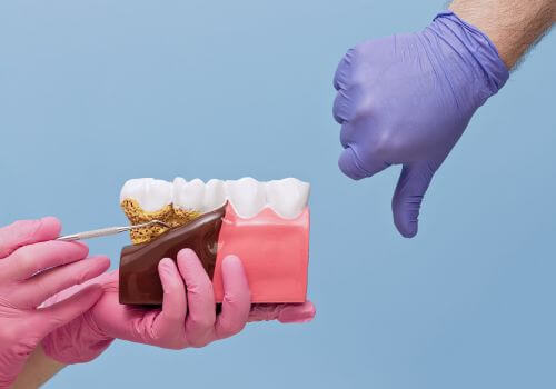 Gingivitis is one of the most common dental problems. Model of gingivitis in humans.