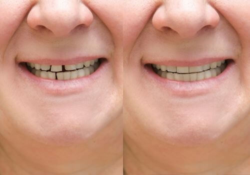Adult woman, before and after dental bonding and clear aligners.