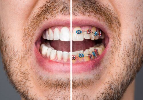 Before and after of metal braces.